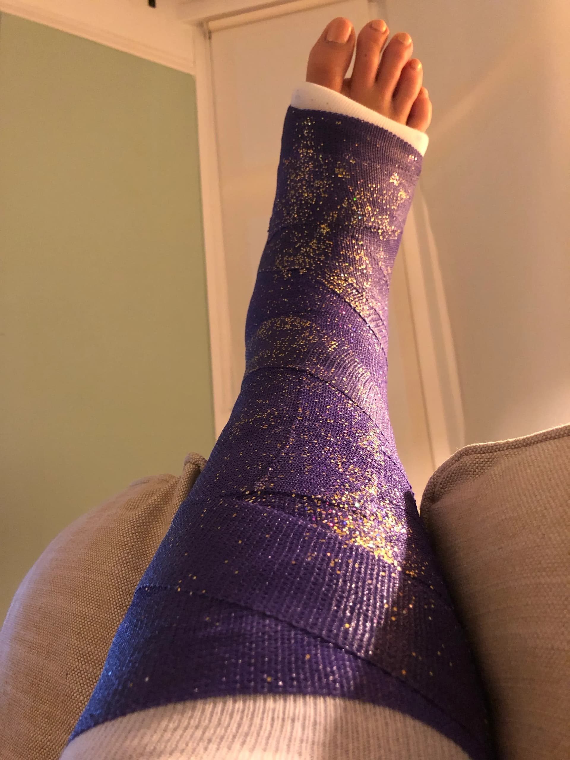 Vivien's ankle in a sparkly purple plaster cast